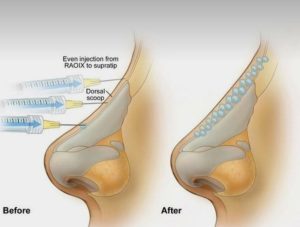 تجميل الانف اللاجراحي من خلال طريقتين الفلر او الخيوط اللاجراحية